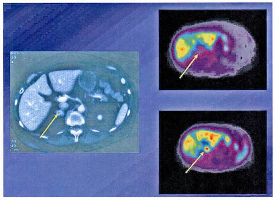 Molecular Imaging Radiotherapy: Theranostics for Personalized Patient ...