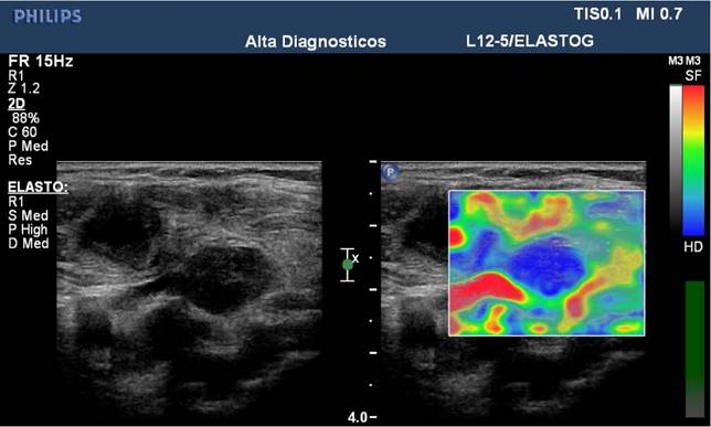 B-mode ultrasound, color Doppler, and sonoelastography in differentiation  between benign and malignant cervical lymph nodes with special emphasis on  sonoelastography, Egyptian Journal of Radiology and Nuclear Medicine