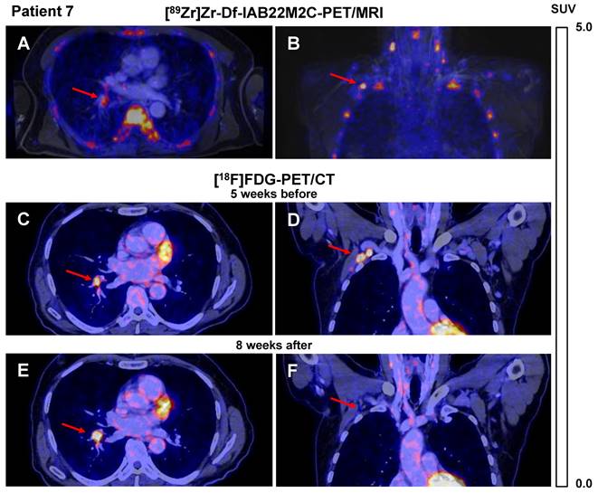 In vivo imaging of CD8+ T cells in metastatic cancer patients: first ...